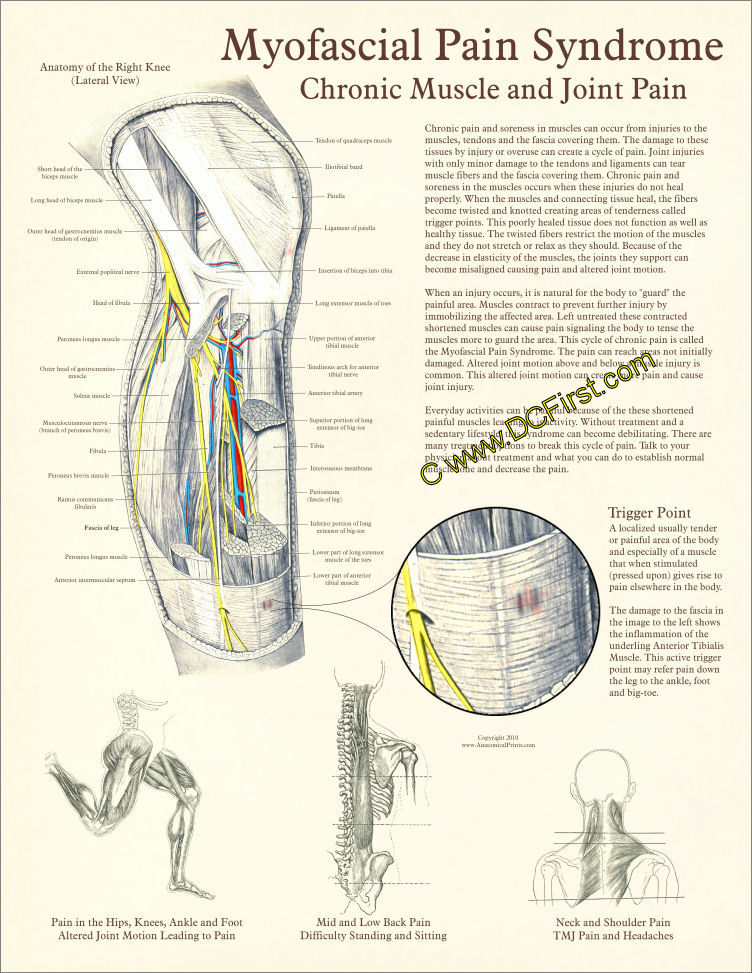 Myofascial Pain Syndrome Poster