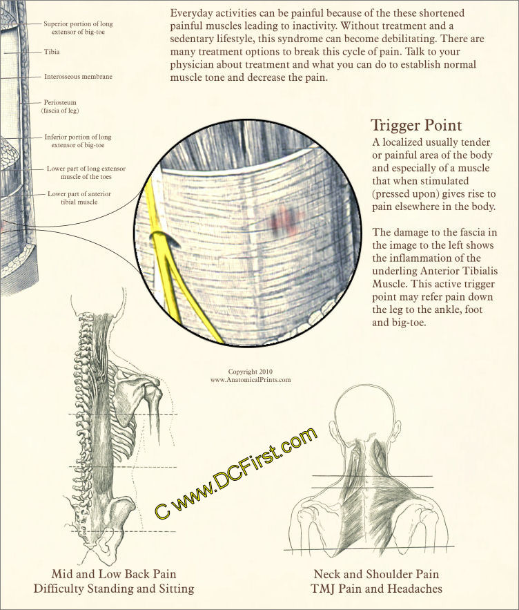 Myofascial Pain Syndrome Poster