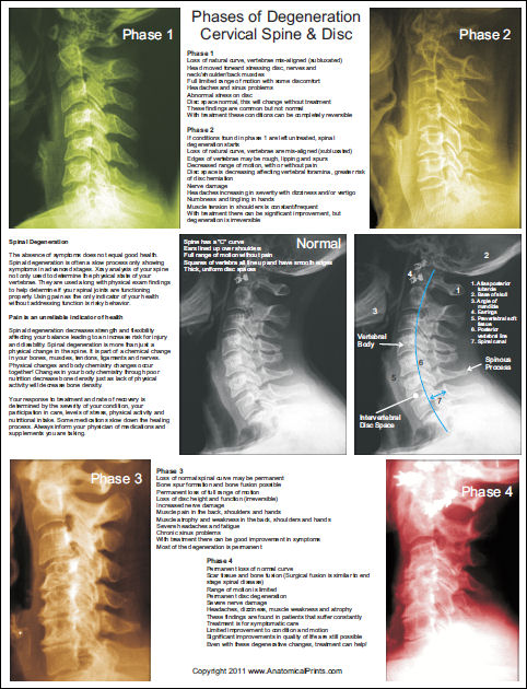 Spinal Degeneration Poster