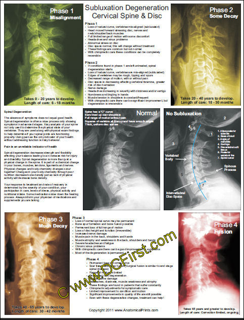 Subluxation Degeneration Poster