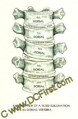 Spinal Nerves and Subluxations Poster
