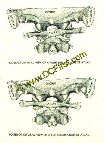 Spinal Nerves and Subluxations Poster