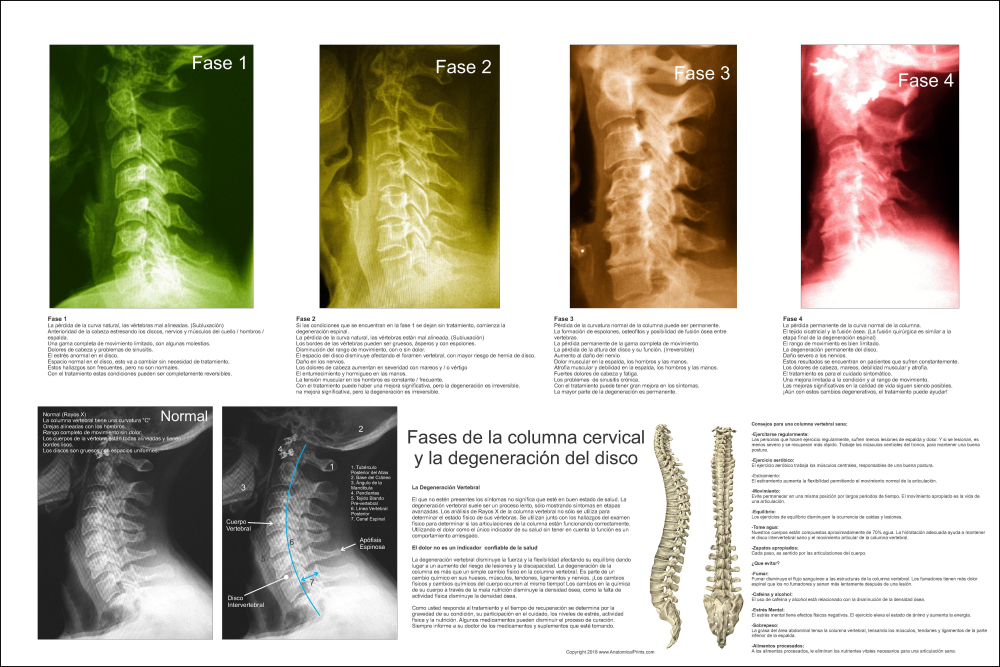 Spanish Spinal Degeneration Poster